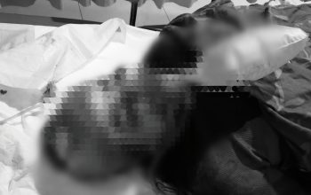 Perempuan terbaring di tempat tidur rumah sakit, luka di wajah terlihat