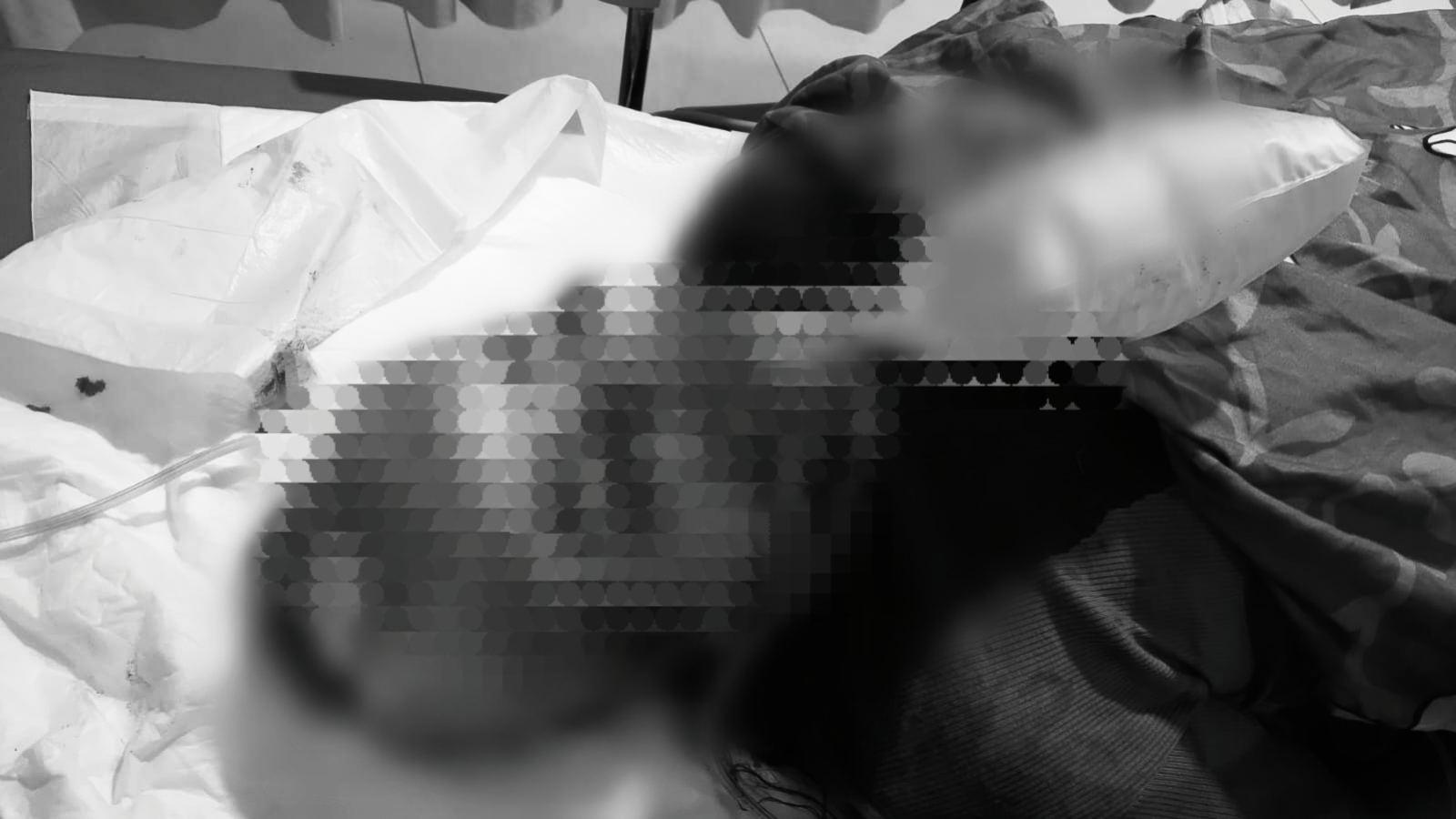 Perempuan terbaring di tempat tidur rumah sakit, luka di wajah terlihat